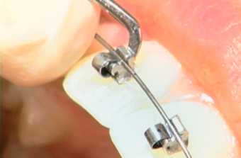 Opening-SPEED-By-Gingival-Dimple