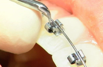 Opening-SPEED-By-Labial-Window