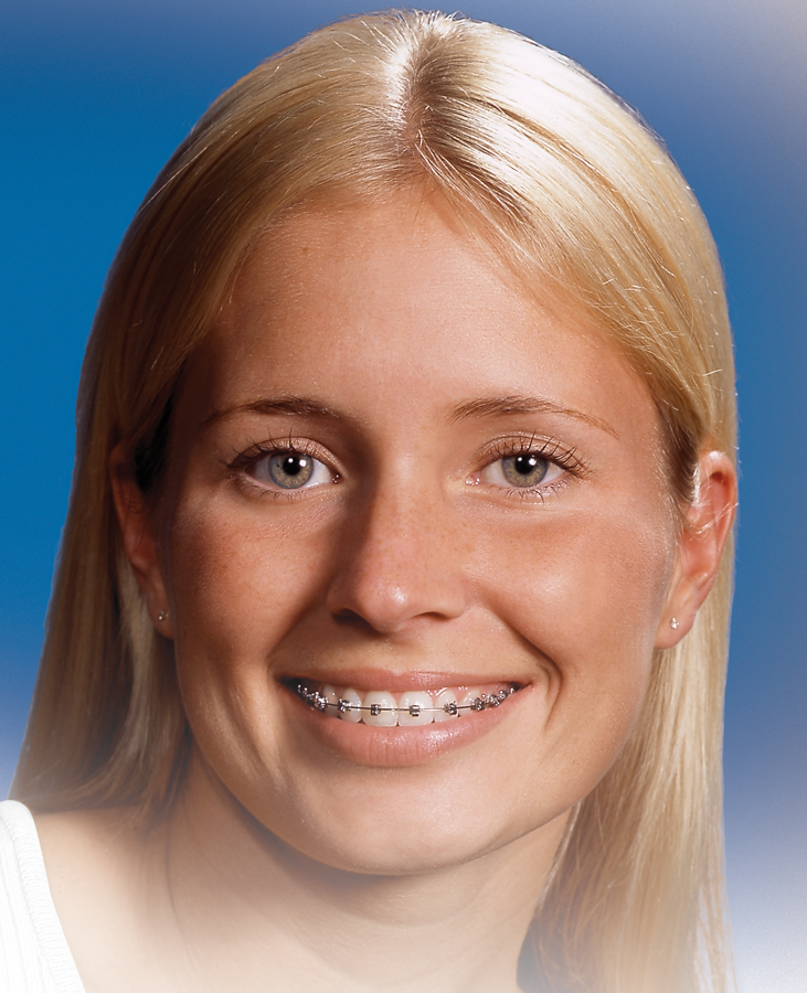 SPEED_braces_on_patient1